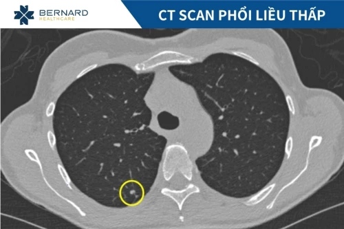 Chụp CT scan phổi liều thấp